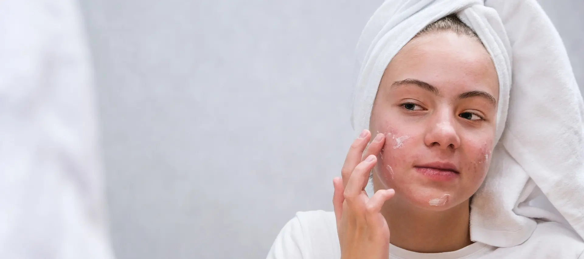 Acné Rétentionnelle vs Acné Inflammatoire : Tout comprendre Image