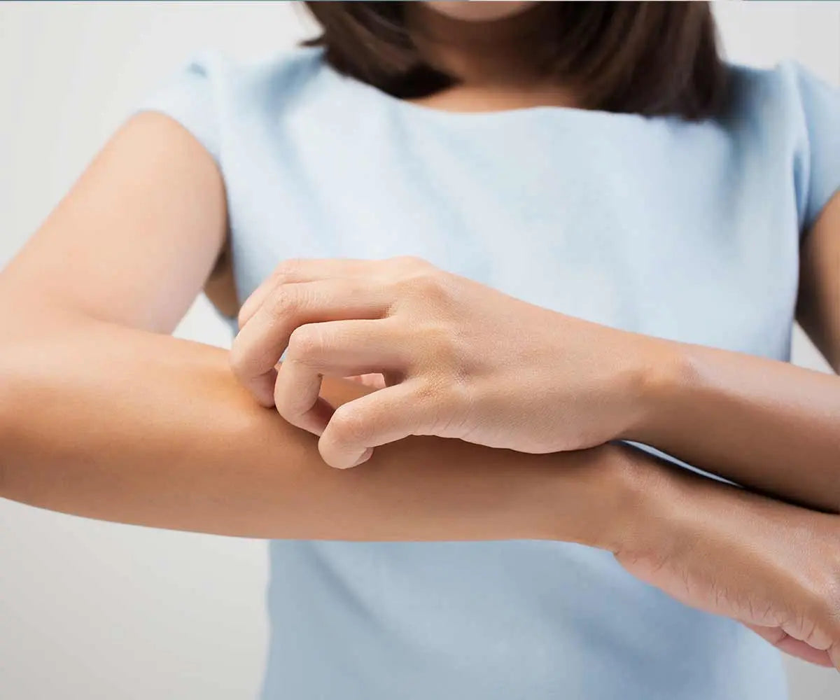 L'eczéma : définition, causes & symptômes