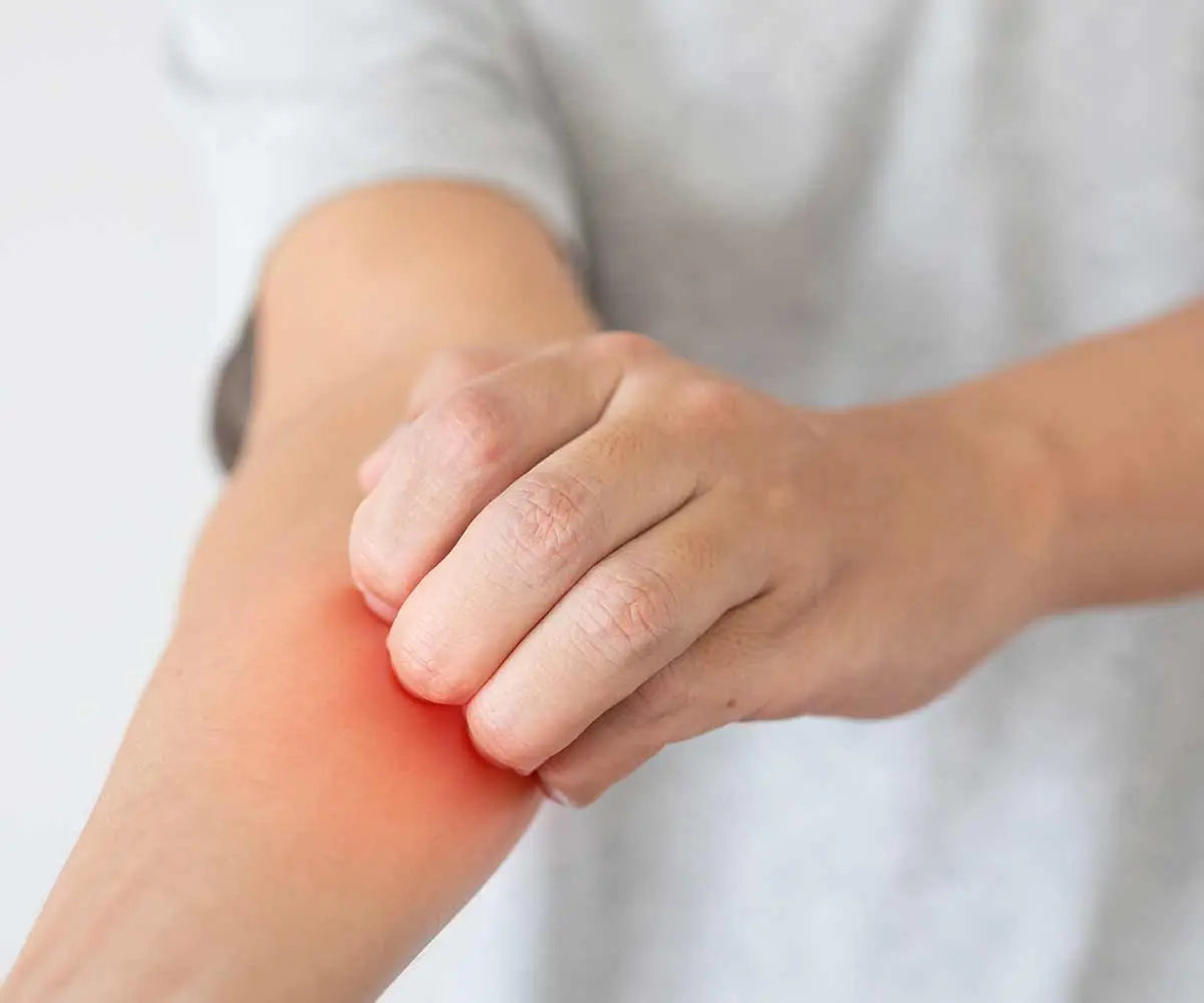 Le psoriasis : définition, causes et symptômes