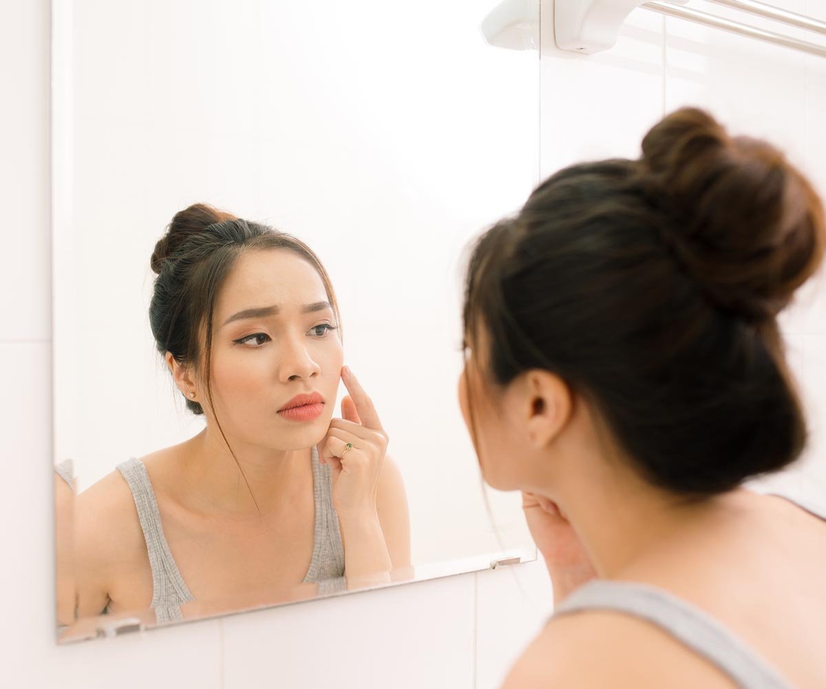 Comment reconnaître et soigner l’acné hormonale ? - KADALYS